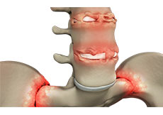 Ankylosing Spondylitis