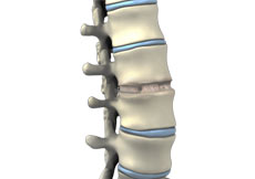 Anterior Lumbar Interbody Fusion