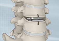 Artificial Cervical Disc Replacement