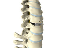 Cervical Arthroplasty