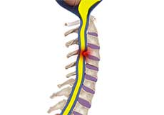 Cervical Deformities