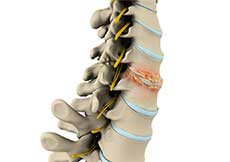 Cervical Degenerative Disorder