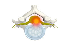 Cervical Disc Protrusion