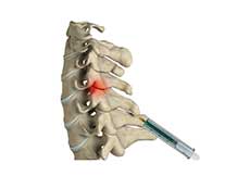 Cervical Facet Blocks