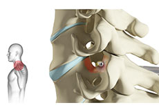 Cervical Foraminotomy