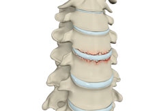 Cervical Fracture