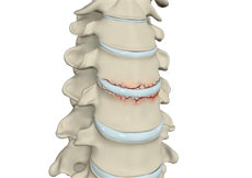 Cervical Herniated Disc