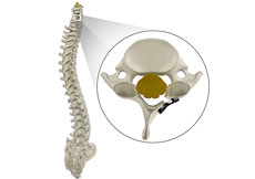 Cervical Laminoplasty