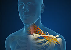 Cervical Radiculopathy/Myelopathy