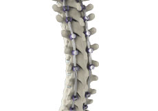 Complex Spine Surgery