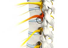 Compression of Thoracic Nerve