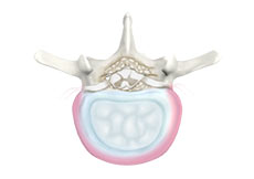 Degenerative Disc Disease