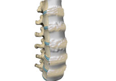 Diffuse Idiopathic Skeletal Hyperostosis