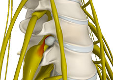 Disc Herniation