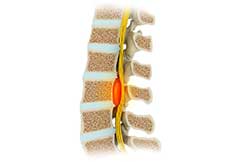 Epidural Abscess