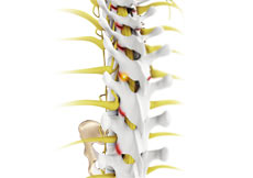 Facet Joint Arthritis