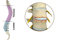 Fracture of the Thoracic and Lumbar Spine