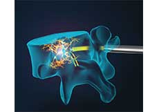 Intracept - Basiventral Nerve Ablation