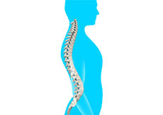 Lordosis