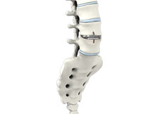 Lumbar Artificial Disc Replacement