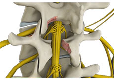 Lumbar Decompression