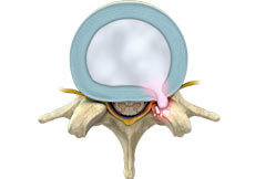 Lumbar Disc Herniation