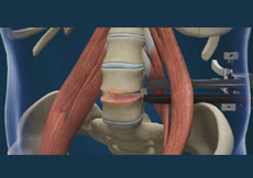 Lumbar Discectomy