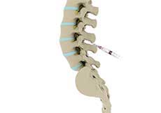 Lumbar Epidurals