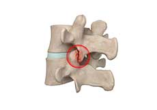 Lumbar Facet Joint Arthropathy