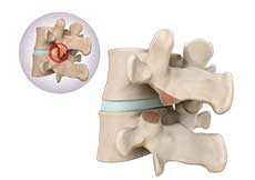 Lumbar Facetectomy and Foraminotomy