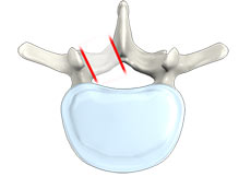 Lumbar Foraminotomy