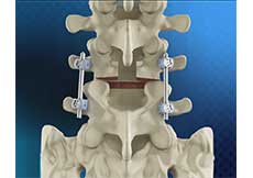 Lumbar Fusion