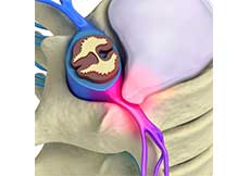 Lumbar Herniated Disc