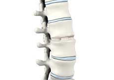 Lumbar Interbody Fusion