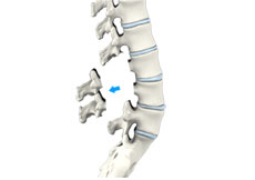 Lumbar Laminectomy