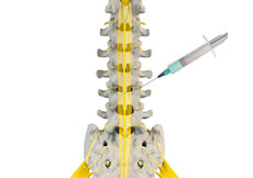 Lumbar Medial Branch Block