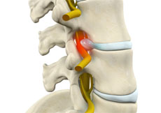 Lumbar Radiculopathy