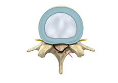 Lumbar Stenosis