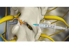 Medial Branch Block Injections