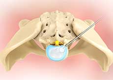 Microdiscectomy