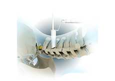 Minimally Invasive Cervical Discectomy