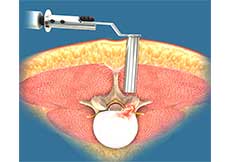 Minimally Invasive Lumbar Decompression