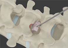 Minimally Invasive Lumbar Discectomy