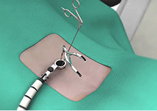 Minimally Invasive Spine Surgery