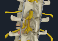 Minimally Invasive TLIF