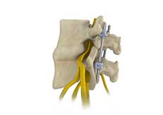 Oblique Lumbar Interbody Fusion