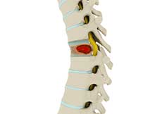 Pathological Fractures of the Spine