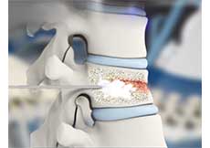 Percutaneous Vertebroplasty