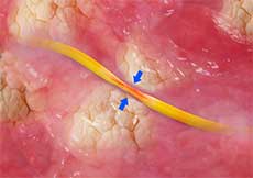 Peripheral Nerve Compression