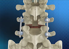 Posterior Lumbar Fusion